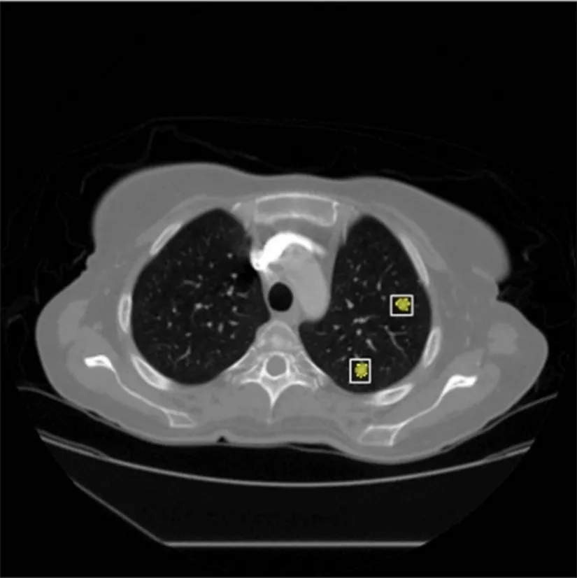 Pulmonary nodule detection and review interface